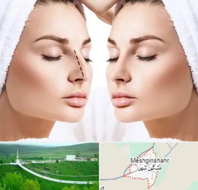 عمل بینی در مشگین شهر