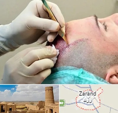 کلینیک کاشت مو در زرند