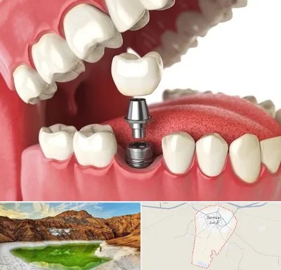 متخصص پروتز دندان در گرمسار