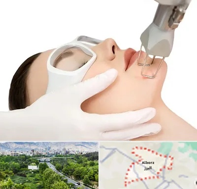 لیزر فرکشنال در البرز