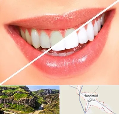 بلیچینگ دندان در هشترود