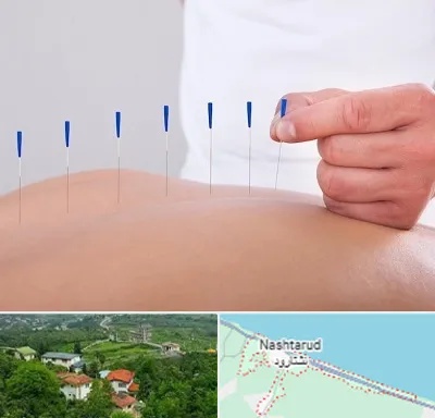 دکتر طب سوزنی در نشتارود