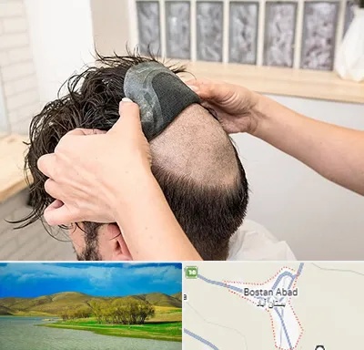 پروتز مو در بستان آباد