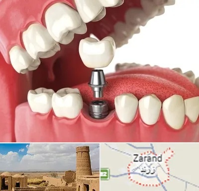 متخصص پروتز دندان در زرند