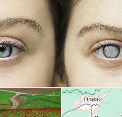 متخصص آب سیاه (گلوکوم) در پارس آباد