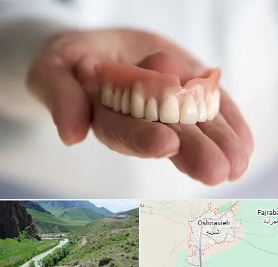 لیفت لثه با لیزر در اشنویه