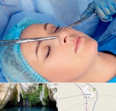 عمل بینی نیمه فانتزی در خورموج