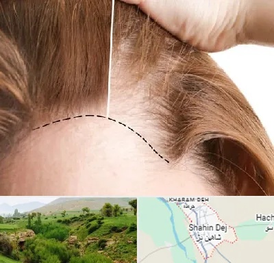 کاشت مو برای خانمها در شاهین دژ