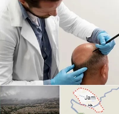 کاشت مو به روش تکثیری در جم