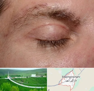 جراح بلفاروپلاستی در مشگین شهر