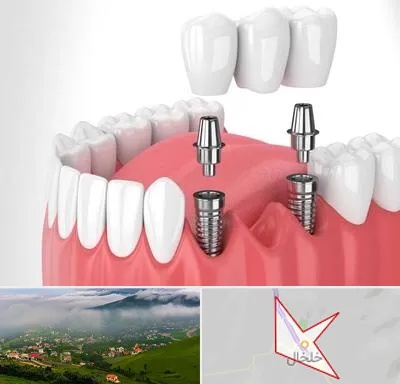 کاشت دندان در خلخال