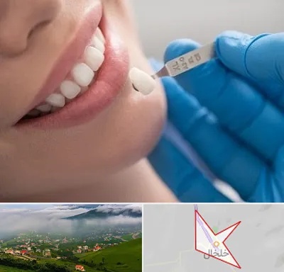 مرکز لمینت دندان در خلخال
