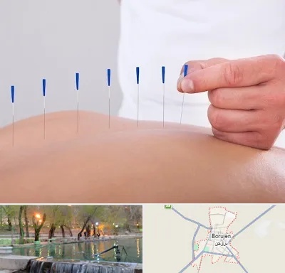 دکتر طب سوزنی در بروجن
