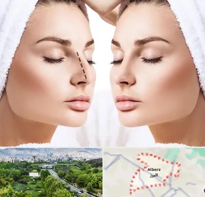 عمل بینی در البرز