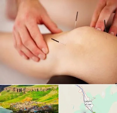 دکتر طب سوزنی برای لاغری در عجب شیر