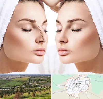 عمل بینی در نقده