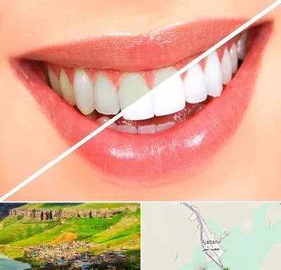 بلیچینگ دندان در عجب شیر