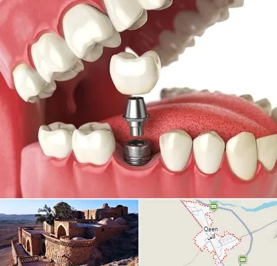 متخصص پروتز دندان در قائن
