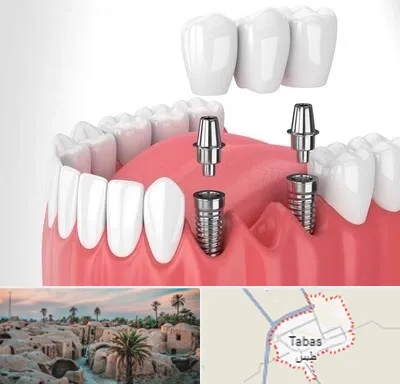 کاشت دندان در طبس