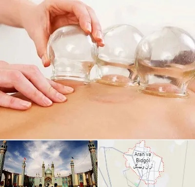 بادکش درمانی در آران و بیدگل