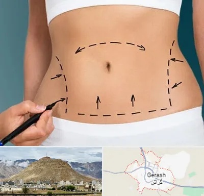 عمل ابدومینوپلاستی در گراش
