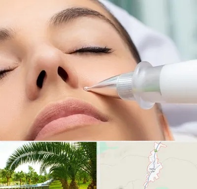 پلاسما جت بینی در کهنوج