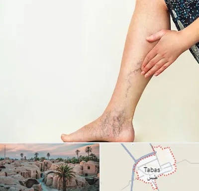 دکتر واریس در طبس