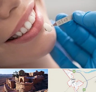 مرکز لمینت دندان در قائن