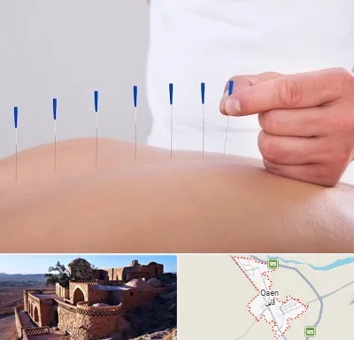 دکتر طب سوزنی در قائن