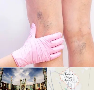 دکتر فوق تخصص واریس در آران و بیدگل