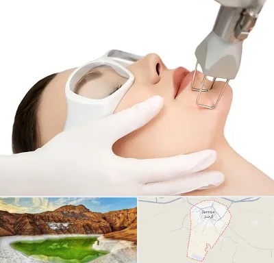 لیزر فرکشنال در گرمسار