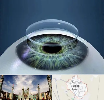 پیوند قرنیه در آران و بیدگل