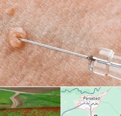 لیزر زگیل تناسلی در پارس آباد