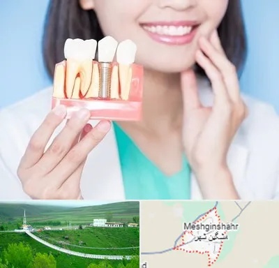 متخصص ایمپلنت در مشگین شهر