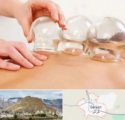 بادکش درمانی در گراش