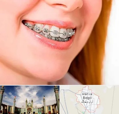 ارتودنسی ارزان در آران و بیدگل