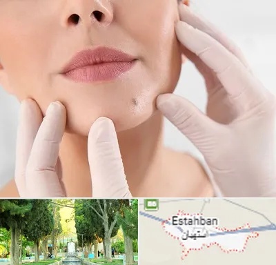 برداشتن خال در استهبان