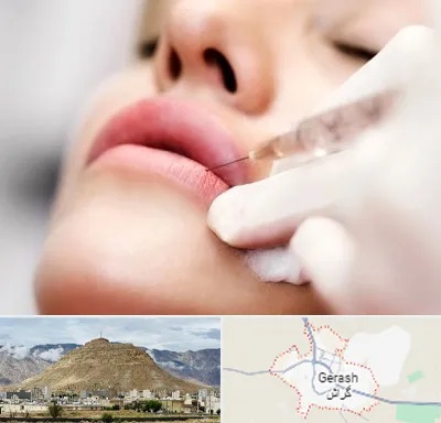 کلینیک تزریق ژل لب در گراش