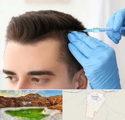 مزوتراپی مو در گرمسار