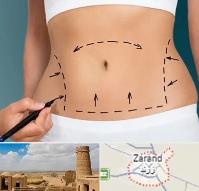 عمل ابدومینوپلاستی در زرند