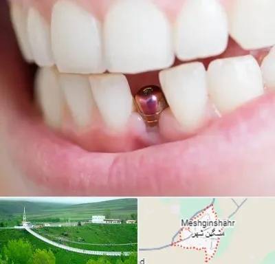 ایمپلنت اقساطی در مشگین شهر