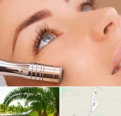 میکرودرم در کهنوج