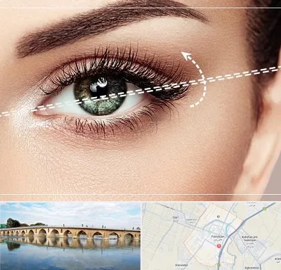جراحی چشم گربه ای در فلاورجان