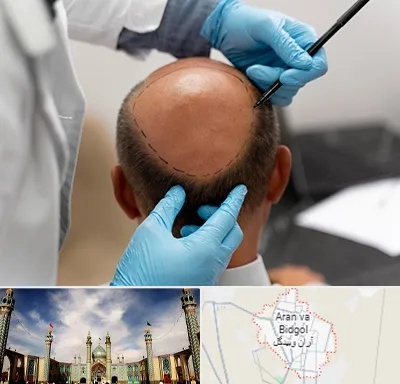 آموزش کاشت مو در آران و بیدگل