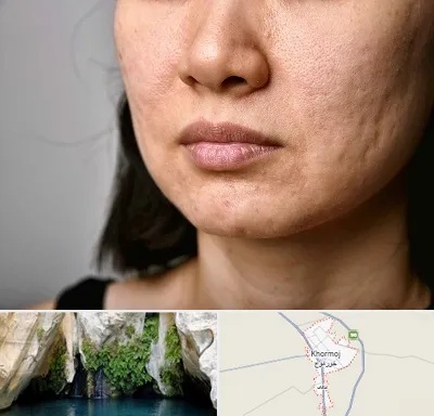 سابسیژن جای جوش در خورموج