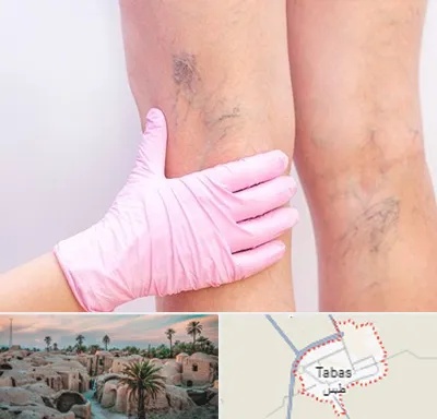 دکتر فوق تخصص واریس در طبس