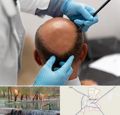 آموزش کاشت مو در بروجن