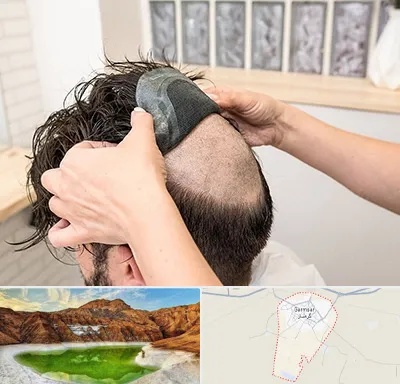 پروتز مو در گرمسار