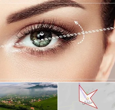 جراحی چشم گربه ای در خلخال