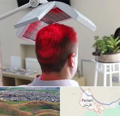 کاشت مو با لیزر در فارسان